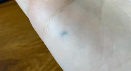 【身体冷知识】扎进肉里的笔芯最后都去哪了