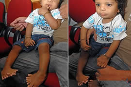 世界上手指脚趾最多的人，印度婴儿14个手指/20脚趾