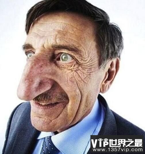 世界上最大的鼻子，长度8.8厘米，巨型大鼻子闻名世界（图1）