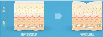 怀孕为什么会长妊娠纹
