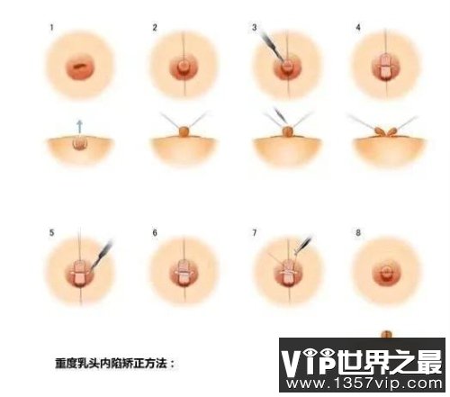 可以通过手术矫正