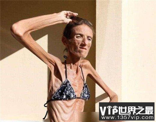 世界上最瘦的人，减肥过度宛如干尸（体重仅20公斤）